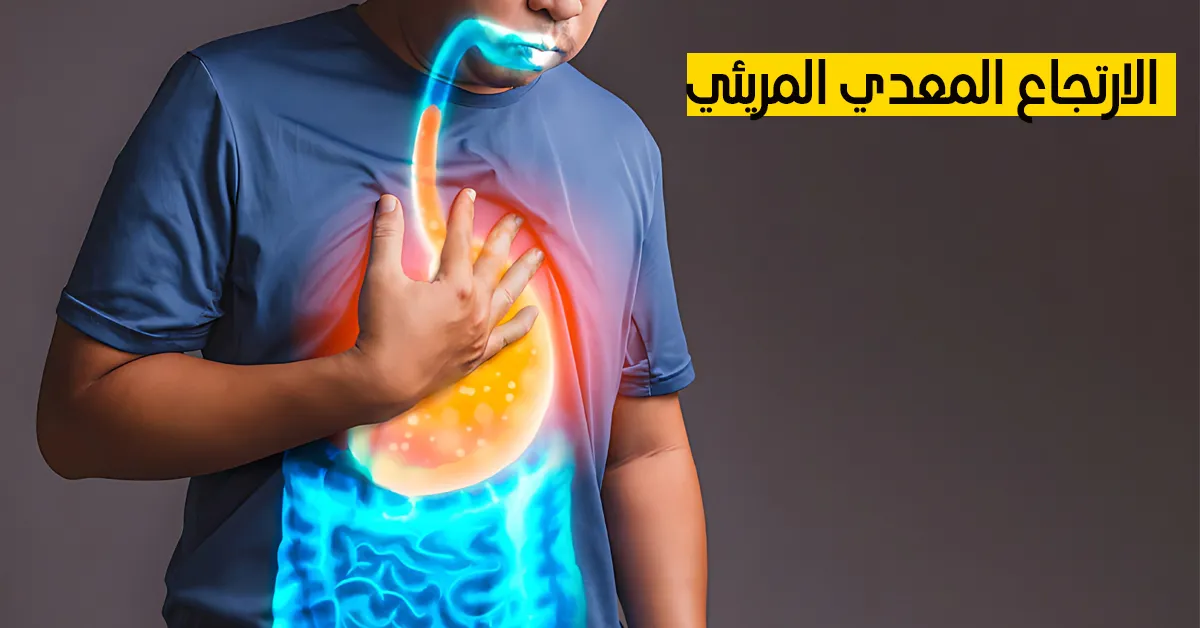 الارتجاع المعدي المريئي